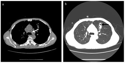 Talaromycosis from Wuhan: two-case report and literature review